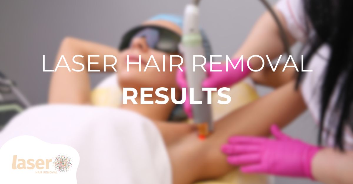 Laser hair removal results after 2 to 3 sessions