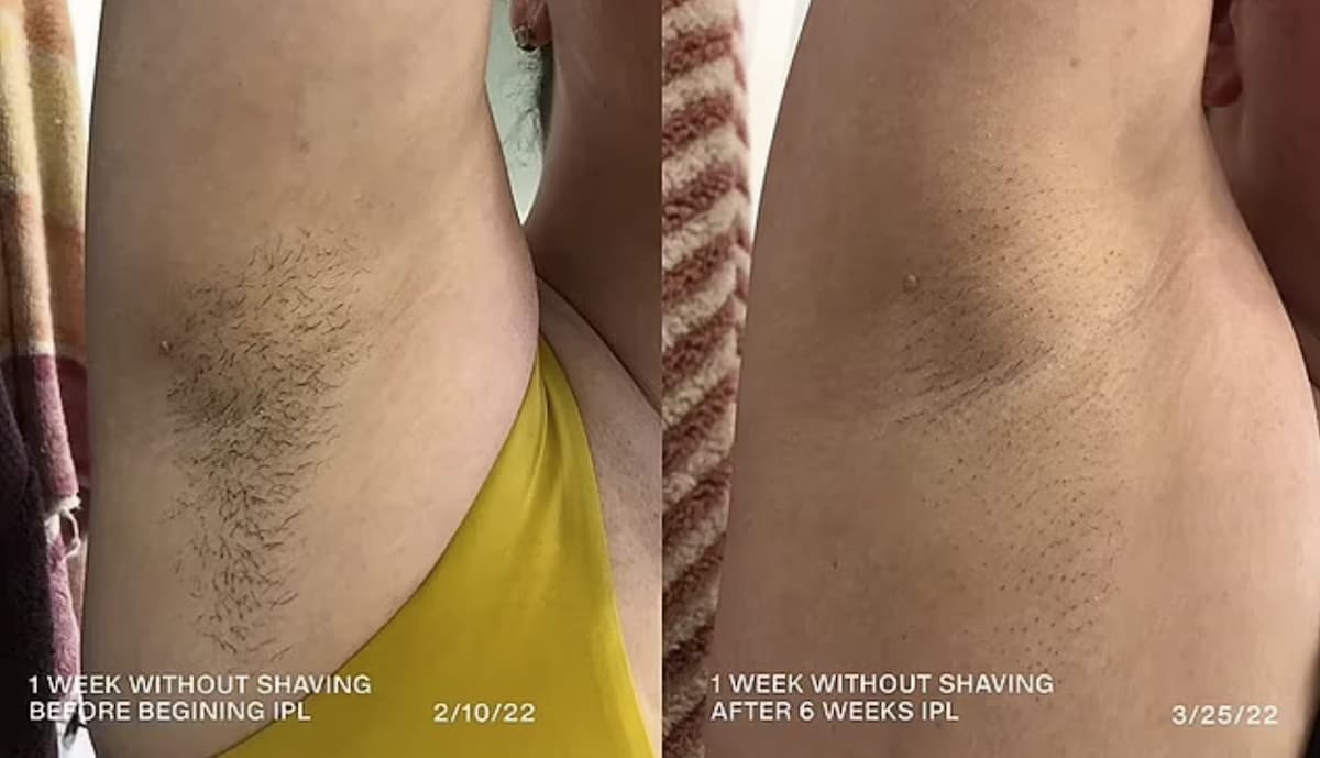 Before and after braun device