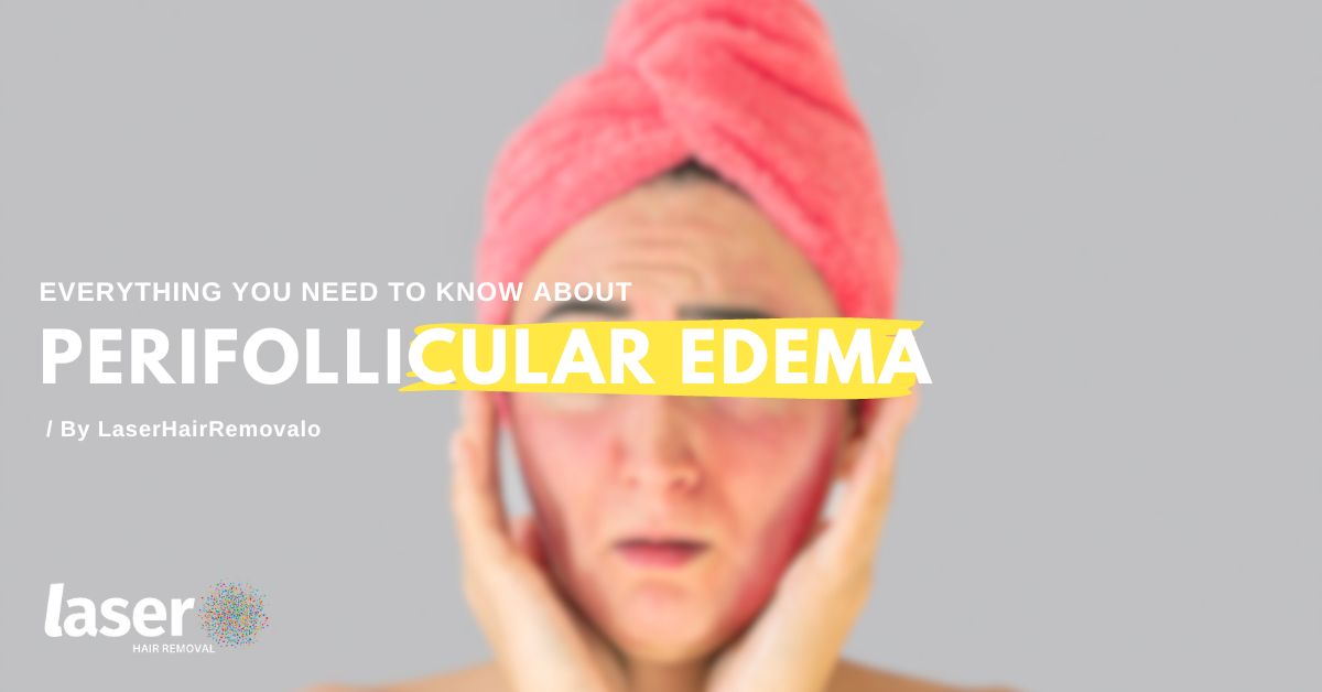 Perifollicular edema Image banner