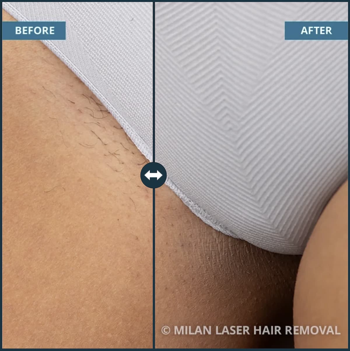 Bikini Laser hair removal before and after